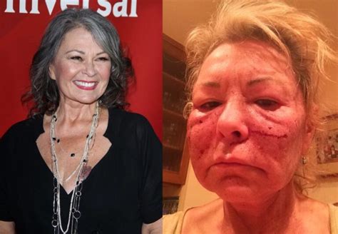 Roseanne Barr Before And After Archives Wealthy Peeps