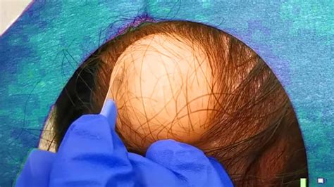 Giant Scalp Cyst Popping Dbs Pilar Cyst Removal Youtube