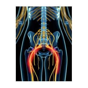 Painful Sciatic Nerve Artwork Photograph By Sciepro Science Photo Library