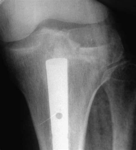 Pre Operative Anteroposterior Radiograph Of A Type Iii Tibial Plateau