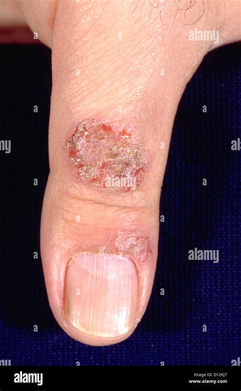 Discoid Eczema Nummular Dermatitis Stock Photo 52305071 Alamy