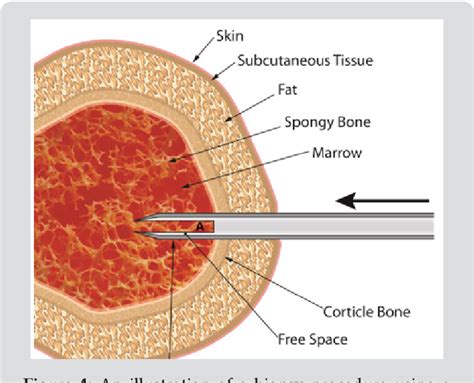 Figure 4 From The Solid Core Trephine Bone Marrow Biopsy Needle