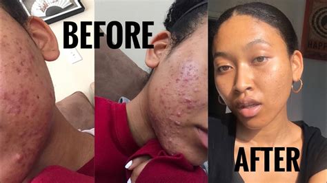 How I Cleared My Terrible Acne Helping You Clear Yours Youtube