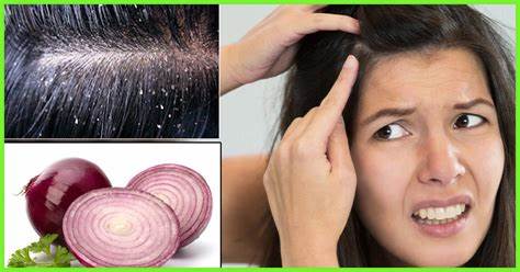 What might Onion Juice Do for Reduce Dandruff?