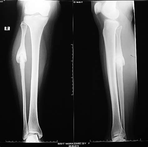 Anteroposterior And Lateral Radiographs Of The Leg Show Lytic Line In
