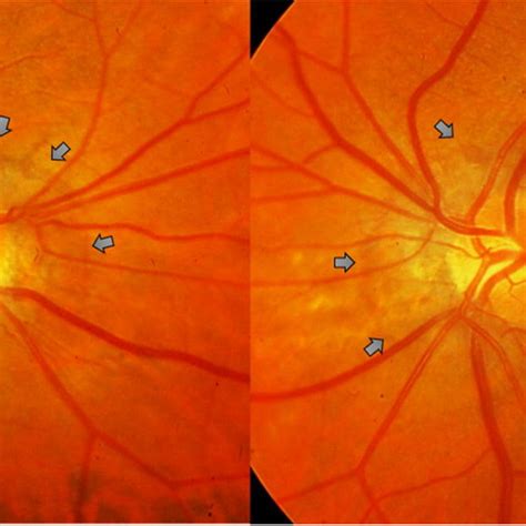 Color Fundus Photography Of Both Eyes Patient 2 Male 44 Years Old And
