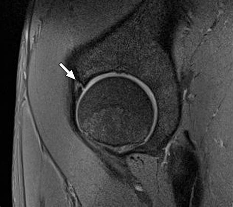 Conventional T Mri And T Mr Arthrography Of Femoroacetabular