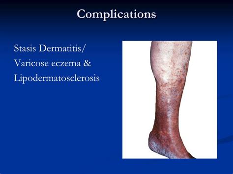 Ppt Varicose Veins More Than Just A Cosmetic Problem Powerpoint