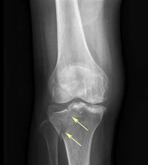 Rit Radiology Tibial Plateau Fracture