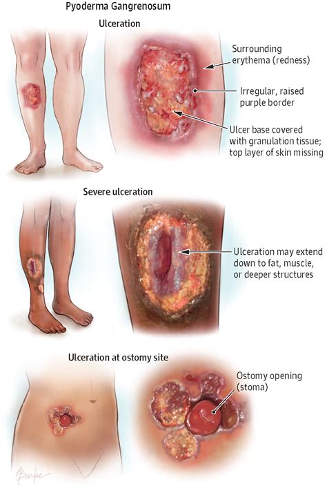 Treatment options include empiric antisecretory therapy, empiric triple therapy for h pylori infection, endoscopy followed by appropriate therapy based on findings, and h pylori serology. Pyoderma Gangrenosum. JAMA Dermatol. 2014;150(9):1032. doi ...