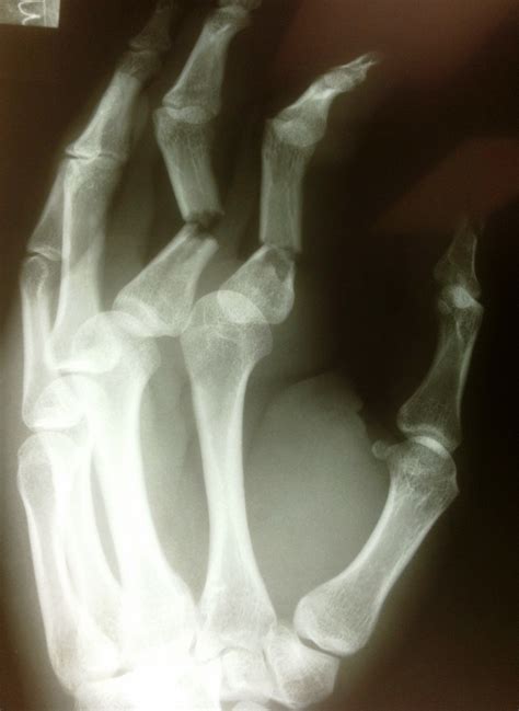 Broken Finger Treatment in Raleigh, NC - Raleigh Hand ...