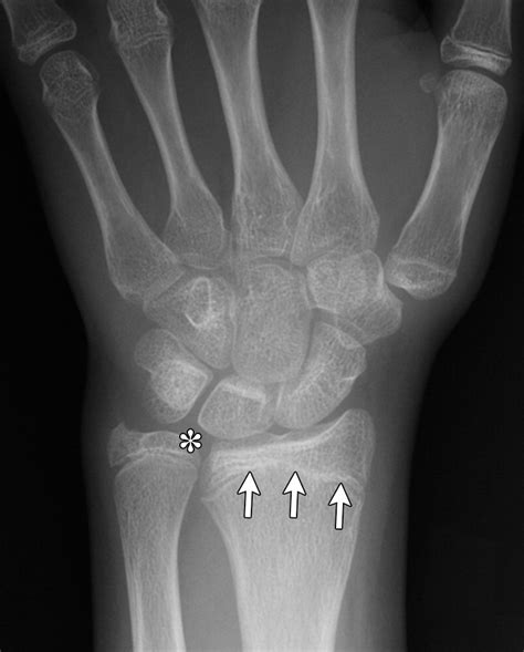 Pediatric Distal Forearm And Wrist Injury An Imaging