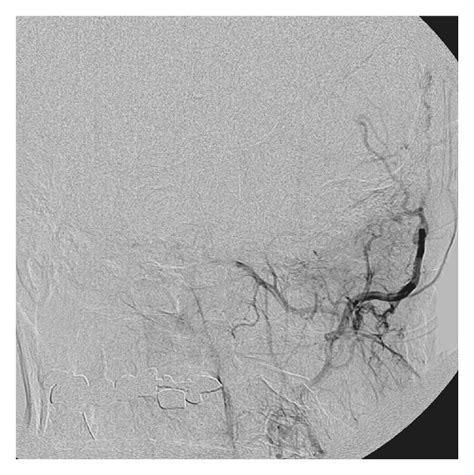 Digitally Subtracted Angiography A Ap And B Lateral Projections