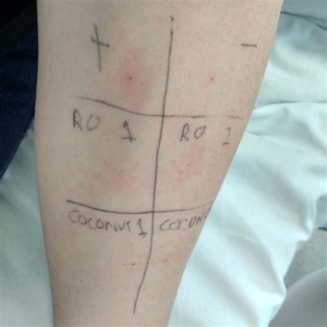 What Happens During Allergy Testing Skin Prick And Challenge Testing