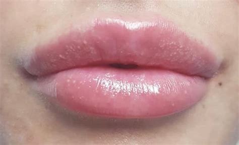 Clear Bump On Lip 💖mucocoele Of The Lip