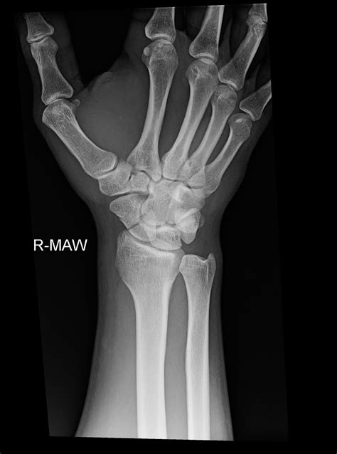 OrthoDx Scaphoid Fracture Clinical Advisor