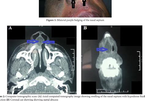 Figure 2 From Unusual Spontaneous Nasal Septal Abscess Semantic Scholar