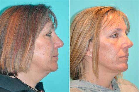 Neck Lift Before And After Photos The Naderi Center For Plastic