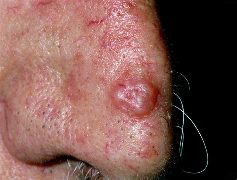 Basal Cell Carcinoma On Nose Of Elderly Man Photograph By Dr P Marazzi