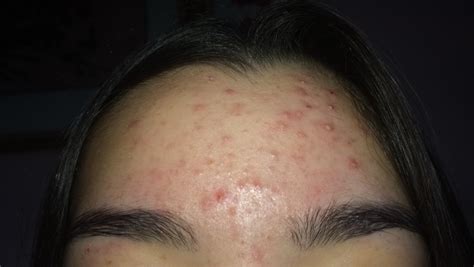 Acne Or Pityrosporum Folliculitis General Acne Discussion Acne Org Forum