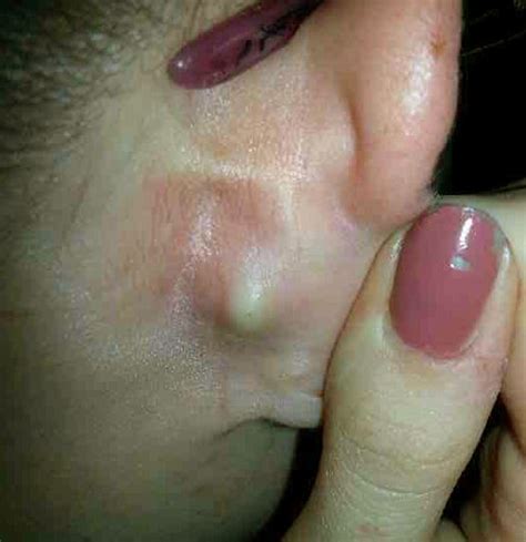 Lump Behind Ear Pictures Symptoms Causes Treatment