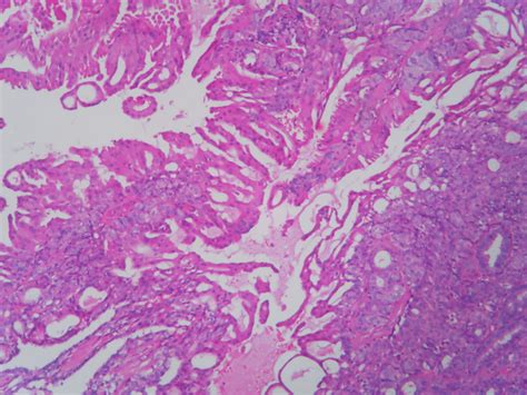 Tubular Adenoma Histopathologyguru