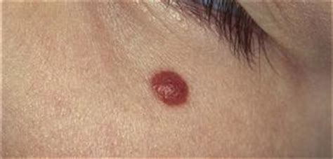 Intradermal melanocytic nevus (dermatoscopic image) een moedervlek is een zichtbare, meestal gepigmenteerde huidaandoening. Intradermal melanocytic nevus | Plastic Surgery Key