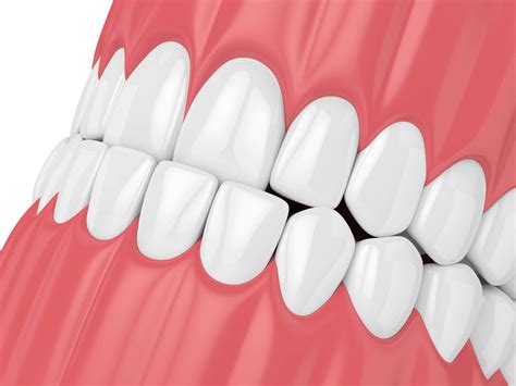 Malocclusione Dentale Cos Prevenzione E Trattamenti