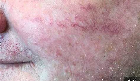 vascular lesions of the skin