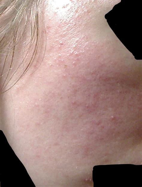 Acne Sudden Acne After Antibiotics Doxycyclinedoryx When Skin Was