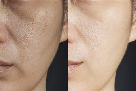 Large Skin Pores