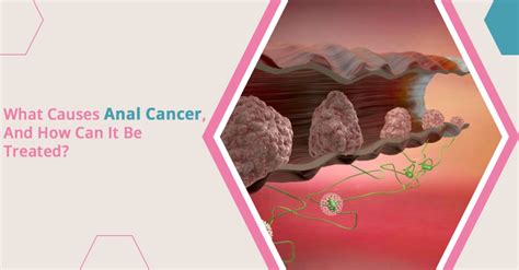 Anal Cancer Causes And Treatment University Cancer Centers University Cancer Centers
