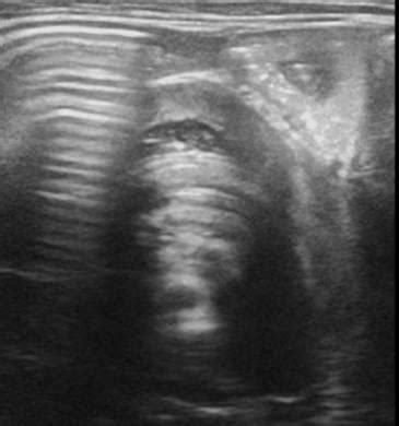 Pediatrics Pediatric Abdomen And Retroperitoneum Case Intussusception Ultrasound