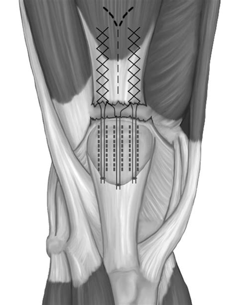 Quadriceps Tendon Rupture Is A Risk News UT Health San Antonio