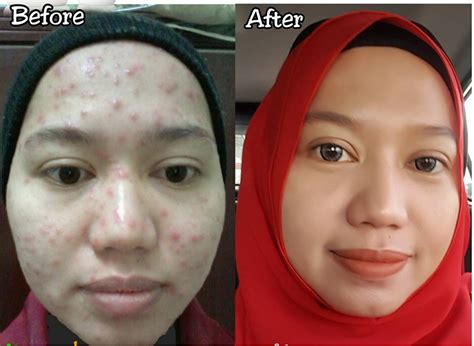 Adakah cara menghilangkan parut chicken pox ini? Parut Chicken Pox Demam Campak Hilang Dengan Shaklee ...