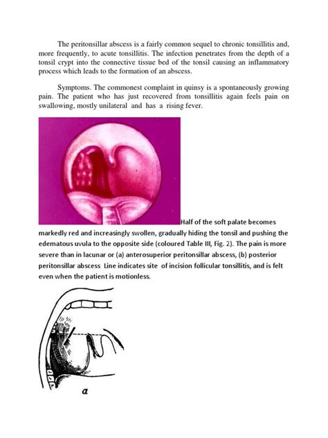 The Peritonsillar Abscess Is A Fairly Common Sequel To Chronic