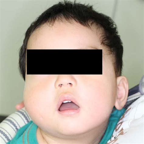 At The Age Of One And A Half His Right Cheek Was Swollen With A Slight