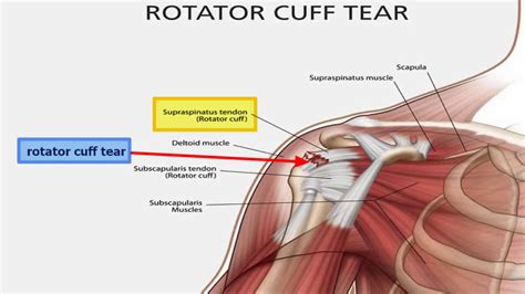 Rotator Cuff Injury Guide Causes Symptoms And Treatment Options My XXX Hot Girl