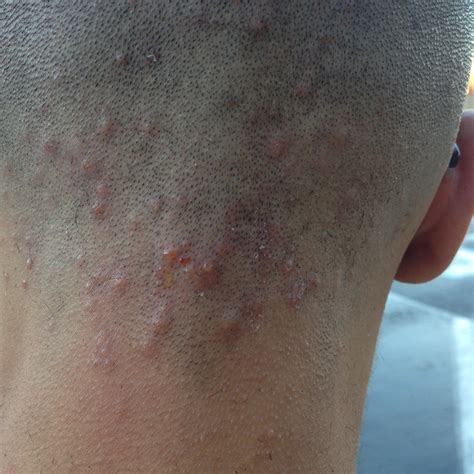 What Can I Do For These Bumps On The Back Of My Head Backbodyneck