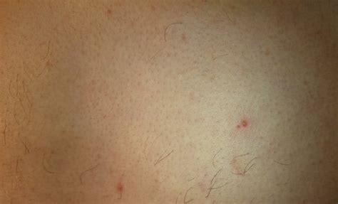 Bedbug bites and mosquito bites can both be red, swollen, and itchy. What do Bed Bug Bites Look Like - Bed Bug Bite Pictures