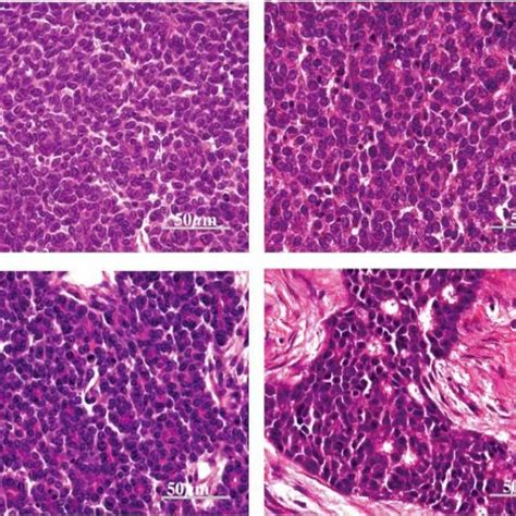 Human Papilloma Virus Associated Koilocytes See Arrows For Selected