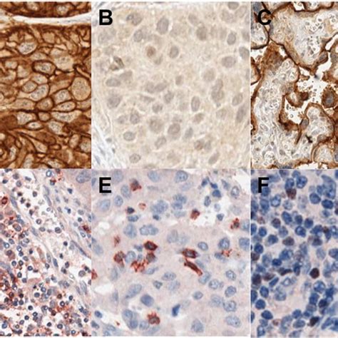 Representative Images Of Immunohistochemical Stains A Strong Pd L1