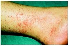 It was originally called black measles because of the look of its rash in the late stages of the illness, when the skin turns black. Rocky Mountain spotted fever - emergency room medical ...