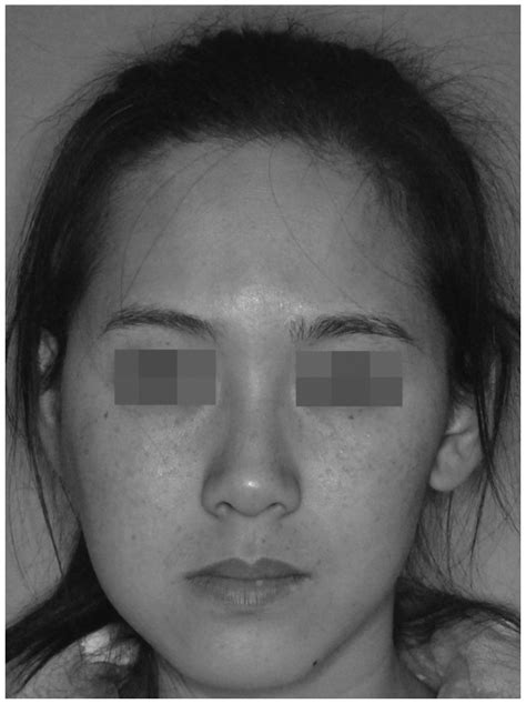 Upon Physical Examination Facial Asymmetry And Slight Right Sided