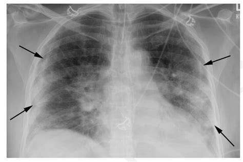 Therefore, at this time, cdph does not recommend changes to testing requirements, even. COVID-19: Making Intelligent use of HRCT Thorax as a ...