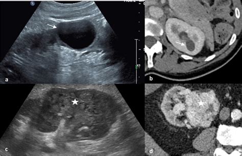 Ultrasound A And Ct B Appearances Of A Simple Cyst With A Thin