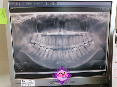 Kesakitan yang berlaku apabila pertumbuhan gigi adalah normal dan sementara. This is Our Story: Pengalaman Mencabut Gigi Bongsu ...