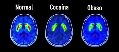El Azúcar Provoca Los Mismos Efectos Que La Cocaína En El Cerebro