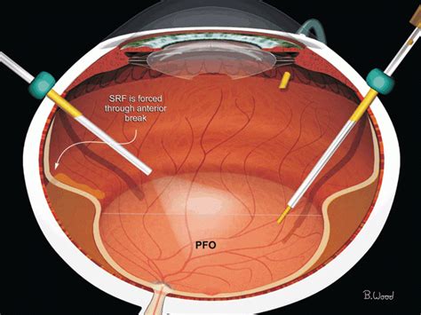 Vitrectomy Or Retinal Detachment