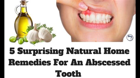 5 Surprising Natural Home Remedies For An Abscessed Tooth Natural
